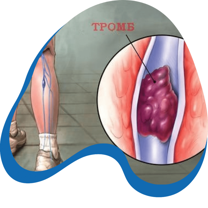 tromb-min